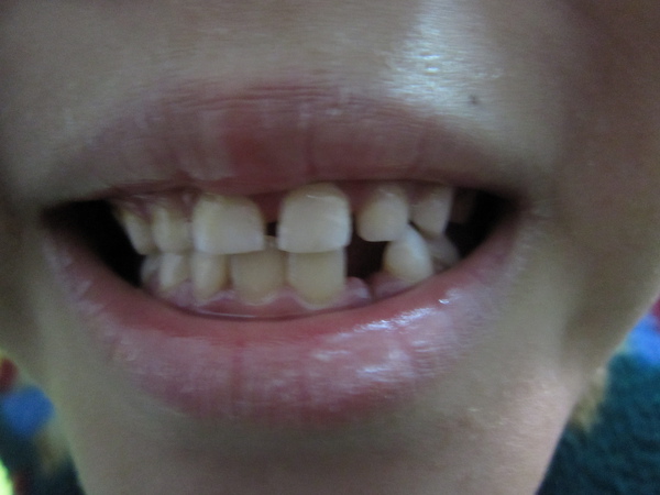 20100103我掉第3顆牙 也是自然掉的喔