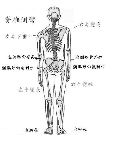 脊椎側彎