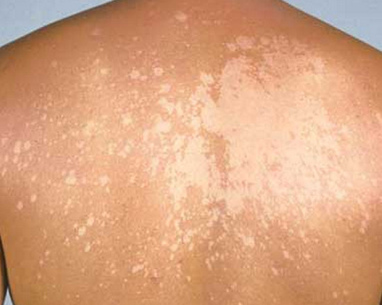 Tinea-versicolor-3.jpg