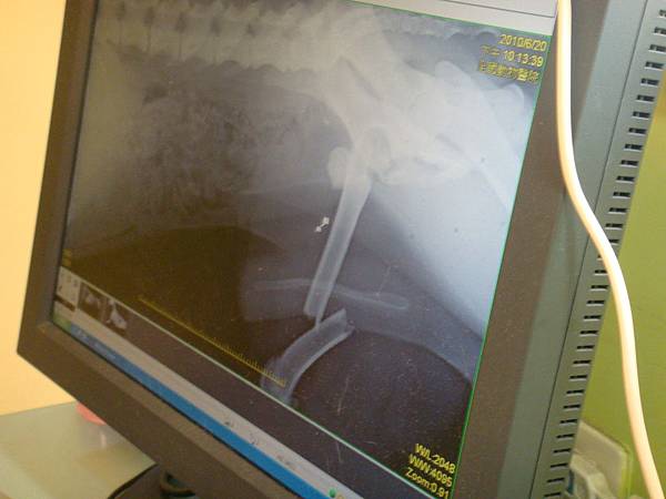 X光結果出爐，大腿骨整根斷掉