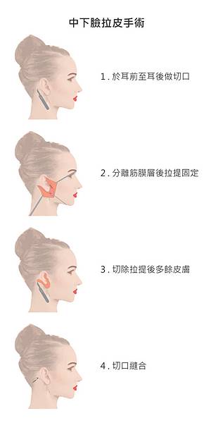 中下臉拉皮手術 中下臉拉皮手術