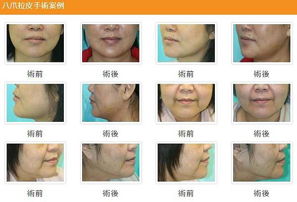 八爪拉皮手術