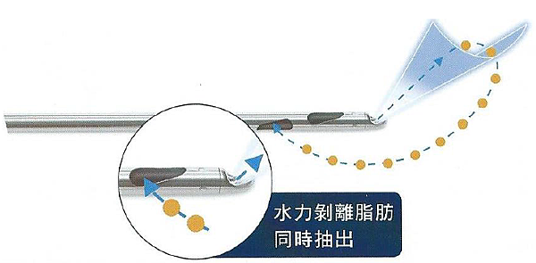 水刀抽脂