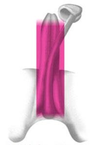 線性震波治療5.jpg 線性震波治療5.jpg