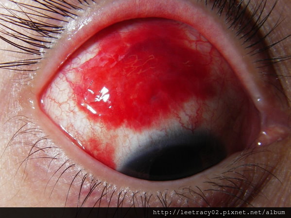 結膜下出血-視保眼科.jpg
