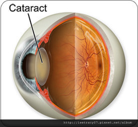 何謂白內障呢?