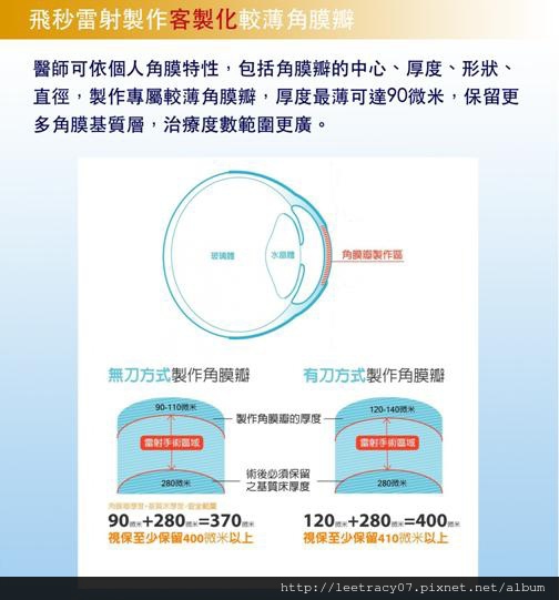 視保眼科飛秒雷射製作客製化較薄角膜瓣.jpg