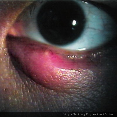 麥粒腫-視保眼科