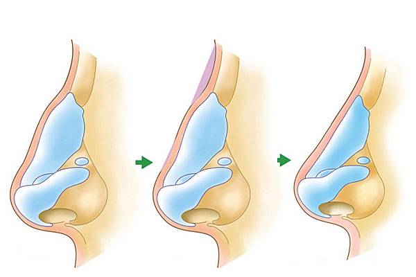 玻尿酸.jpg 玻尿酸.jpg