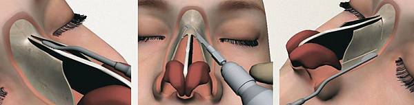 消鼻柱.jpg 消鼻柱.jpg