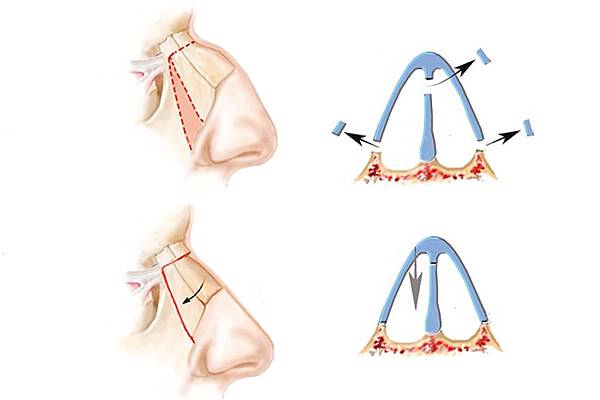 鼻骨切斷.jpg 鼻骨切斷.jpg