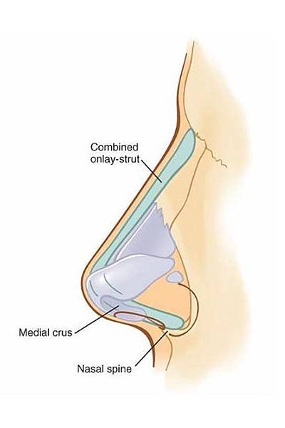 植入物.jpg 植入物.jpg