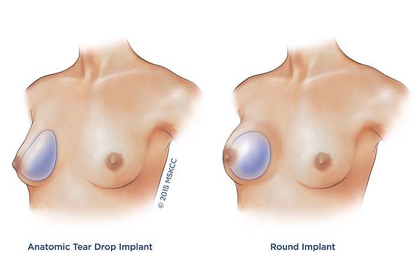 anatomic-versus-round-implants-3x2_0.jpg anatomic-versus-round-implants-3x2_0.jpg