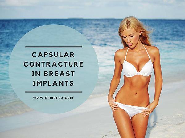 Capsular-Contracturein-Breast-ImPLants-1024x768.jpg Capsular-Contracturein-Breast-ImPLants-1024x768.jpg