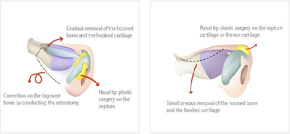 OsteotomyforRhinoplasty-procedure.jpg OsteotomyforRhinoplasty-procedure.jpg