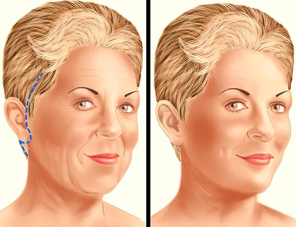 facelift-surgery-traditional-incision.jpg