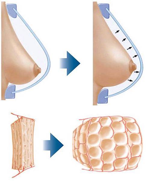 breastaug1.jpg breastaug1.jpg