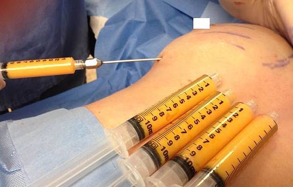 fat-grafting-breast.jpg fat-grafting-breast.jpg