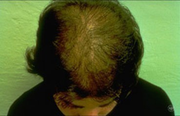 hair-loss-woman.jpg hair-loss-woman.jpg