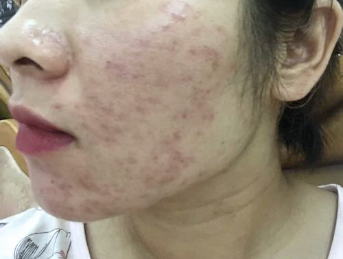 2021毛孔粗大看過來 月球表面變成水煮蛋只花了1個月 痘痘粉刺抗戰血淚 寶佳美wandfor超肌密細化原液 保養推薦排行榜