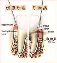 牙周病1