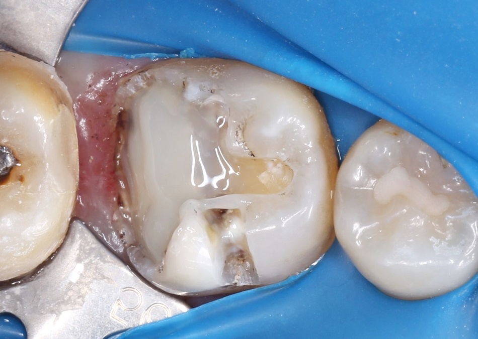 台中牙醫分享-斷牙怎麼辦朗日牙藝美學牙醫快速裝全瓷冠牙齒崩壞免植牙