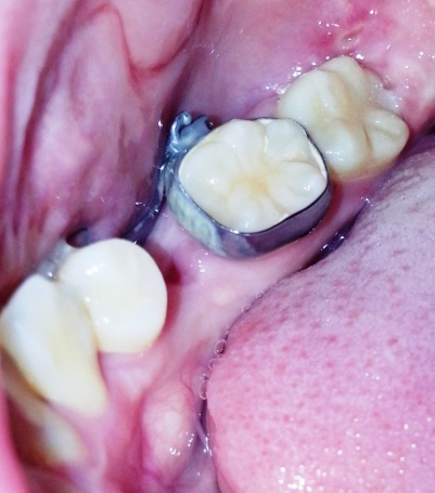 【牙齿矫正】day51 大臼齿补牙