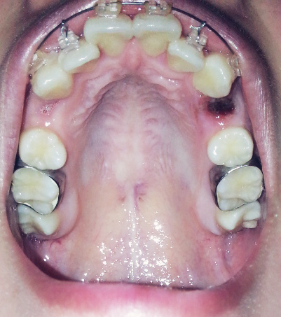 【牙齿矫正】day51 拔牙-最后2颗小臼齿