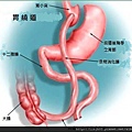 常見減重手術之一