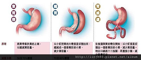 微創減重手術