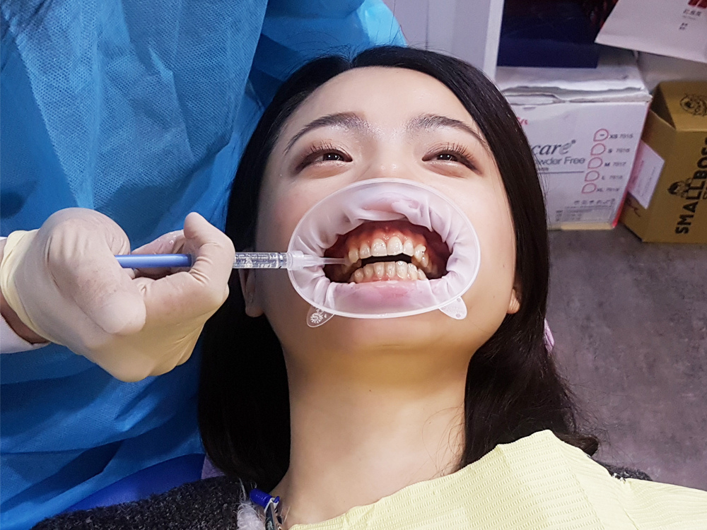 臺北士林悅庭牙醫診所-牙齒美白居家美白雷射美白17.jpg 臺北士林悅庭牙醫診所-牙齒美白居家美白雷射美白17.jpg