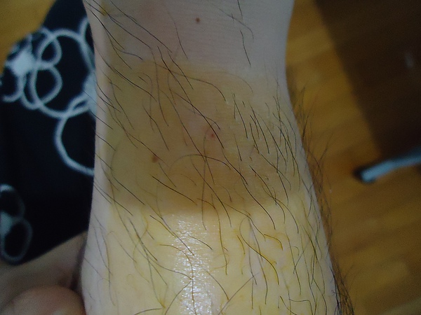 (病)蜈蚣咬到 @ fais un voeu :: 痞客邦 pixnet