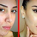 honey-for-acne-before-and-after.jpg