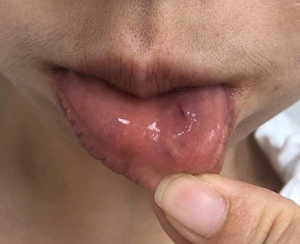 唾液腺囊腫 口腔裡的水泡 Lori S Blog 痞客邦