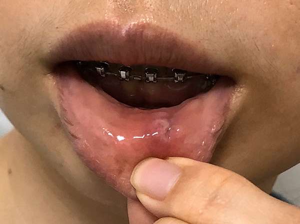 唾液腺囊腫 口腔裡的水泡 Lori S Blog 痞客邦