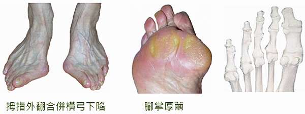足部健康電子報第四十四期 橫弓塌陷的腳容易長厚繭 走路行進的能力較差 足部健康管理 痞客邦