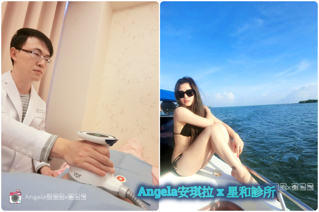 *醫美*肥肚肚剋星 無痛無侵入性輕鬆瘦【歐翠學超音波系統(標靶震波)】桃園醫美星和診所/張惟皓醫師