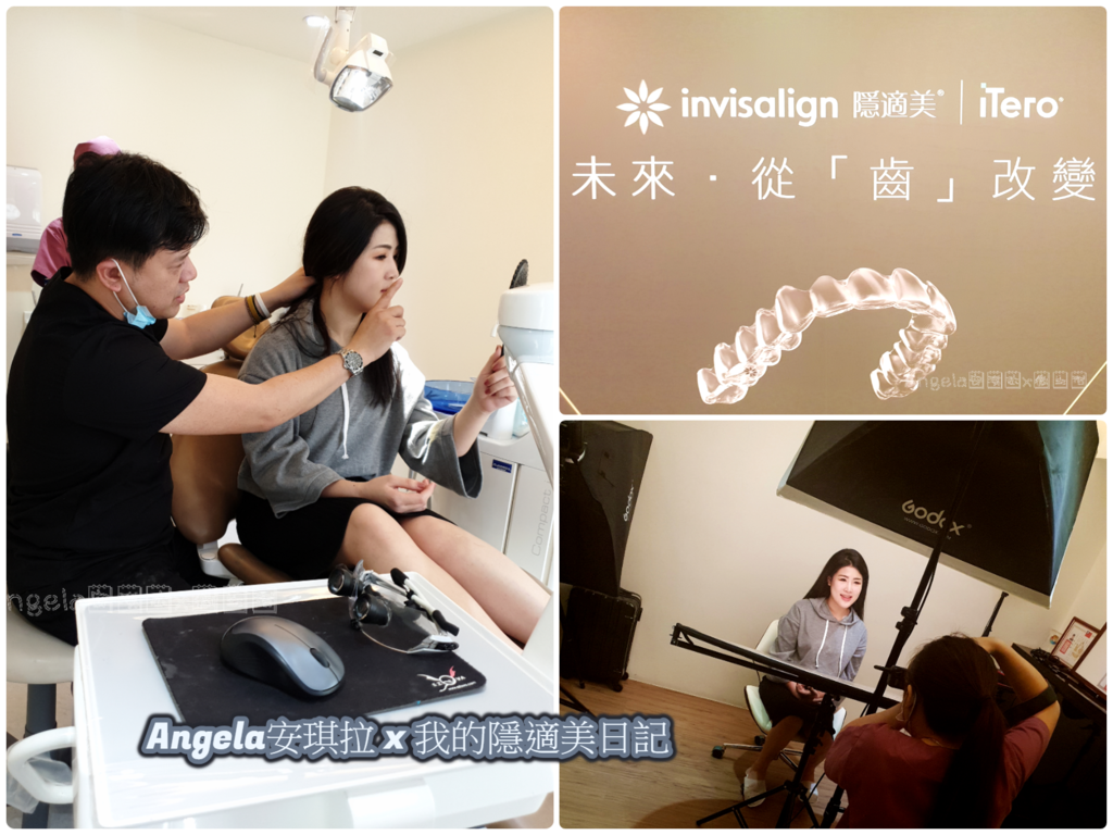 *分享*我的隱適美牙套日記ll隱適美牙齒矯正-口掃、治療計畫篇