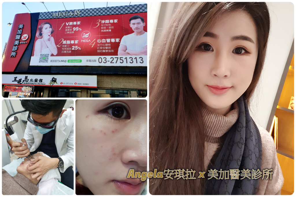 *醫美*皮秒初體驗 改善黑斑/痘疤/毛孔 讓肌膚好透亮 【美加醫美診所-皮秒雷射】