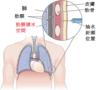 抽肺積水 肋膜積水 Part 2 By小婷 小右的抗癌筆記 痞客邦