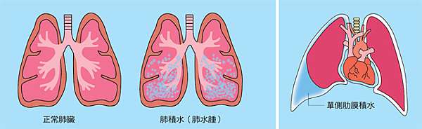 抽肺積水 肋膜積水 Part 2 By小婷 小右的抗癌筆記 痞客邦