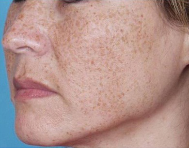 Brown-Spots-on-Face-8