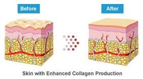 Diagram showing skin with enhanced collagen production
