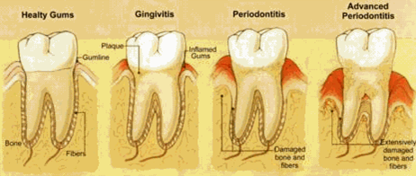 Gingivitis-and-Periodontitis-1.png