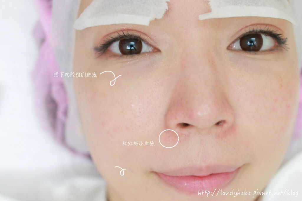 星采大安_櫻花雷射_小季13 星采大安_櫻花雷射_小季13