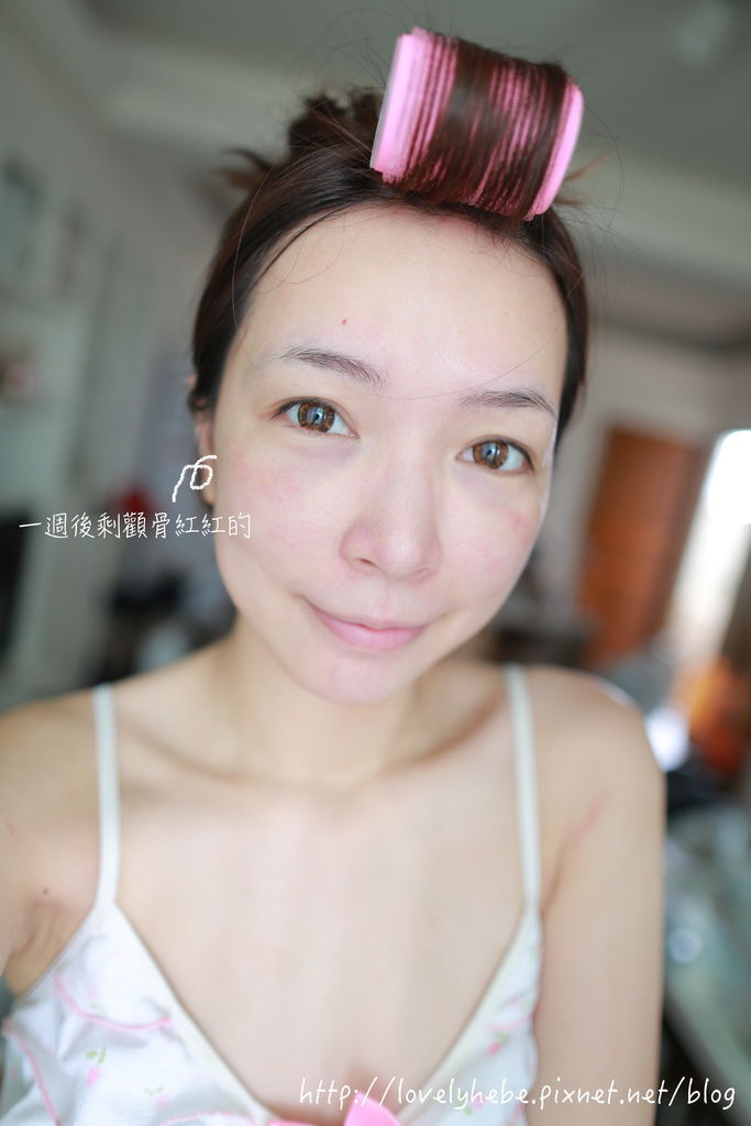 星采大安_櫻花雷射_小季18 星采大安_櫻花雷射_小季18