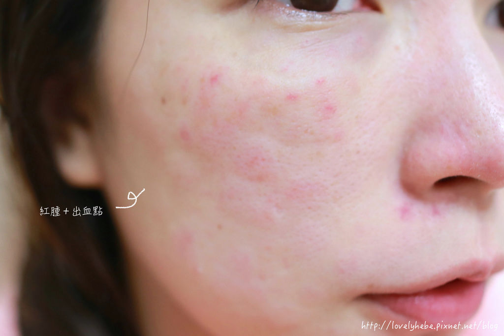 星采大安_櫻花雷射_小季17 星采大安_櫻花雷射_小季17