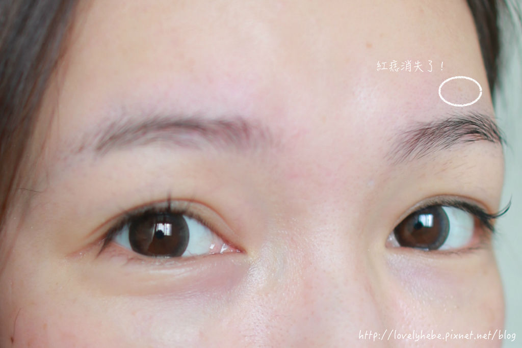 星采大安_櫻花雷射_小季25 星采大安_櫻花雷射_小季25