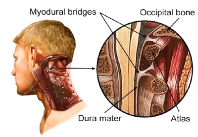 myodural bridge.jpg myodural bridge.jpg