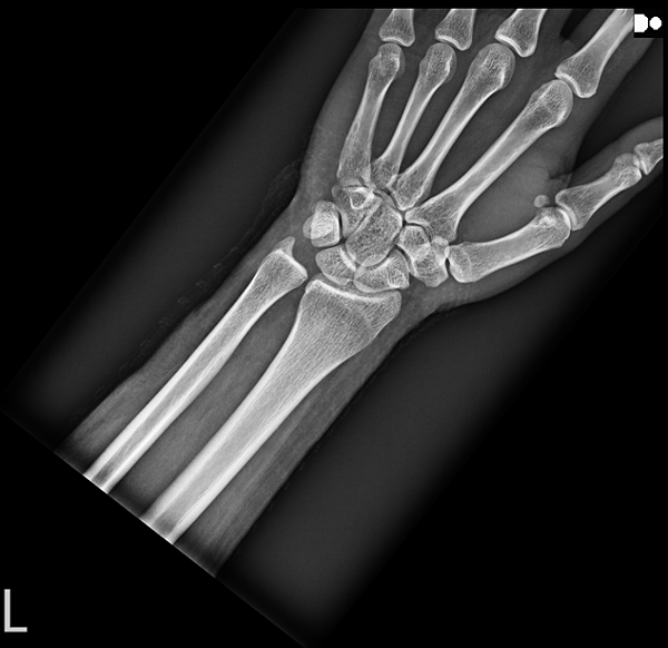 車禍後來個脊骨神經